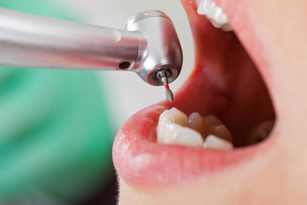 Best Emergency Dentist for Lost Fillings or Crowns in Pleasant Ridge, MI